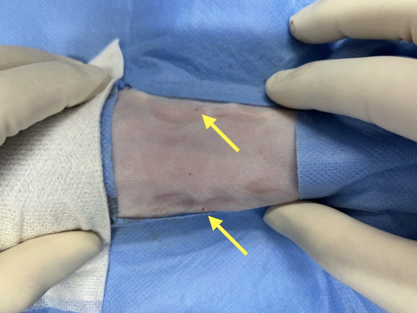 インターベンション